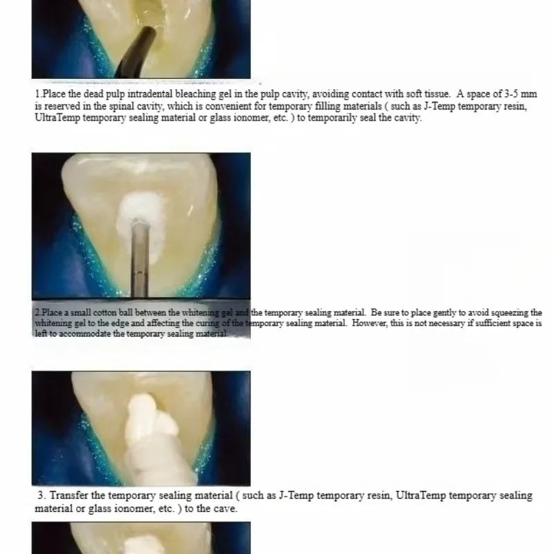 Materiales de restauración buc - Teeth Whitening Effects reseña y precio