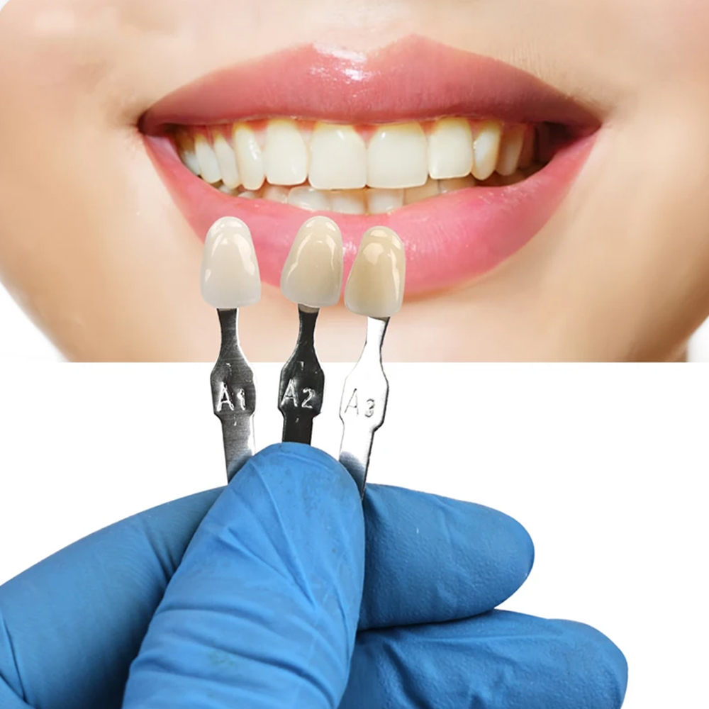 Kit de Blanqueamiento Dental V - Teeth Whitening Shade Guide reseña y precio