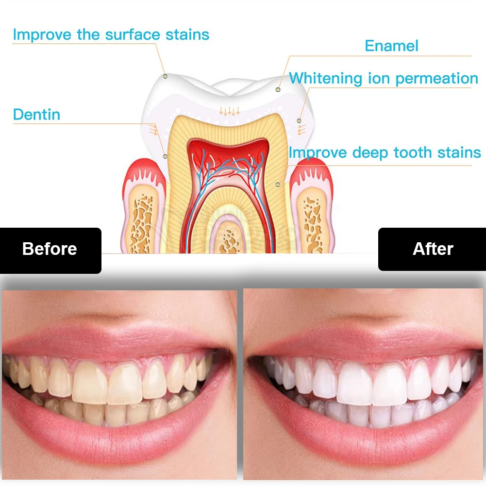 Kit de blanqueamiento Dental M - Teeth Whitening Pens reseña y precio