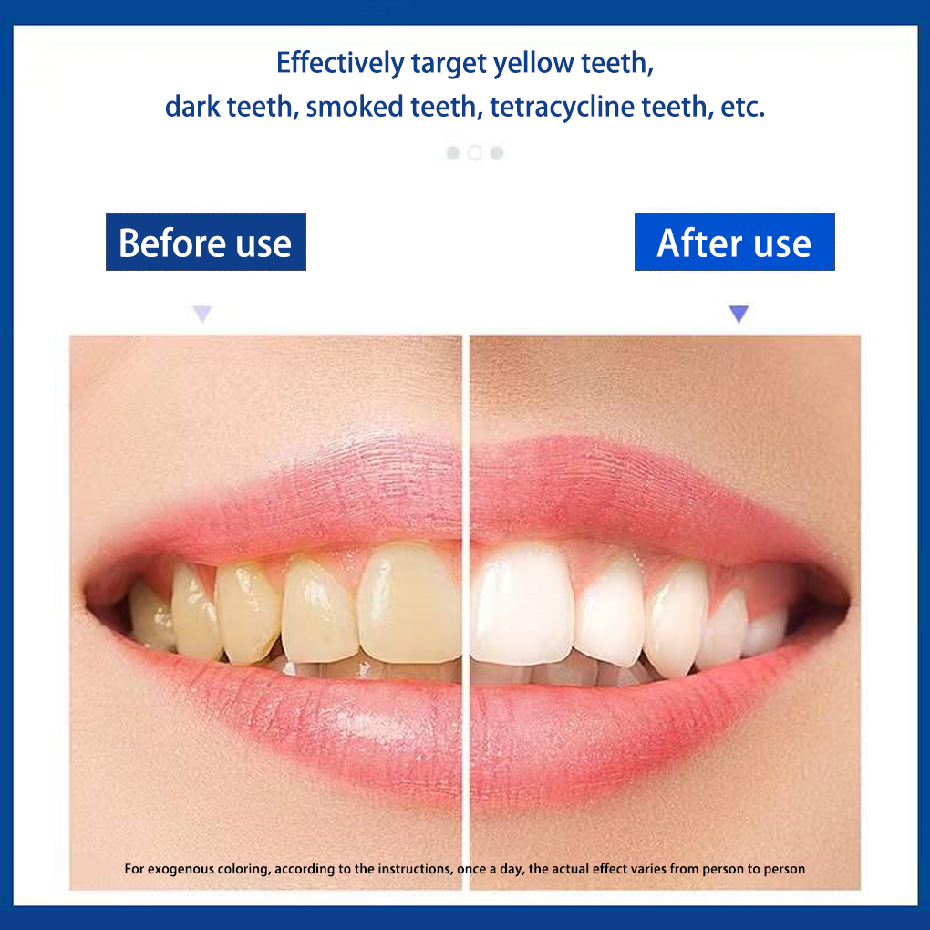 70/140 pares 5D tiras blanquea - Teeth Whitening Effects reseña y precio